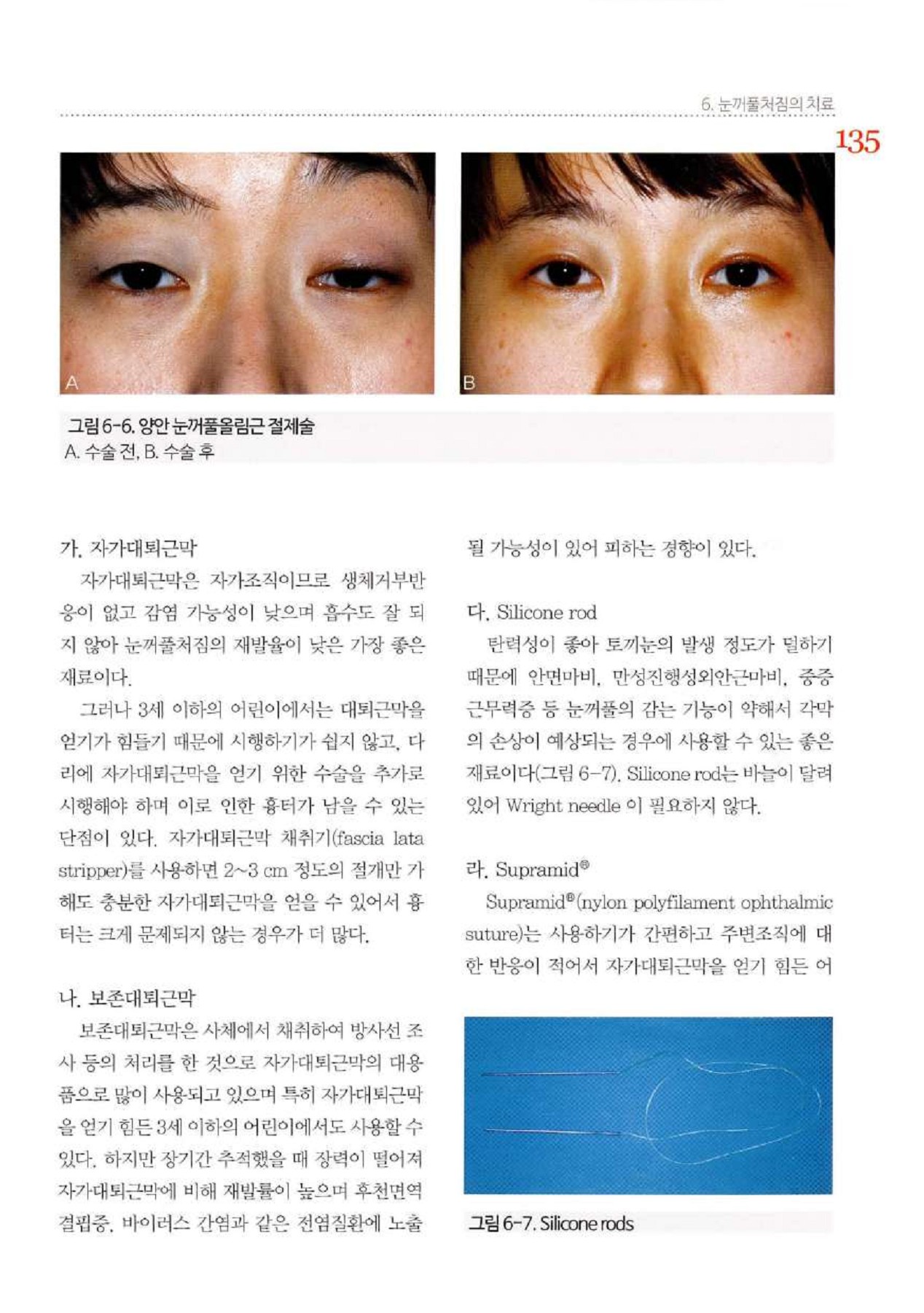 성형안과학 3판 - 플립 북 페이지 151-200 | PubHTML5, image size:1268x1800