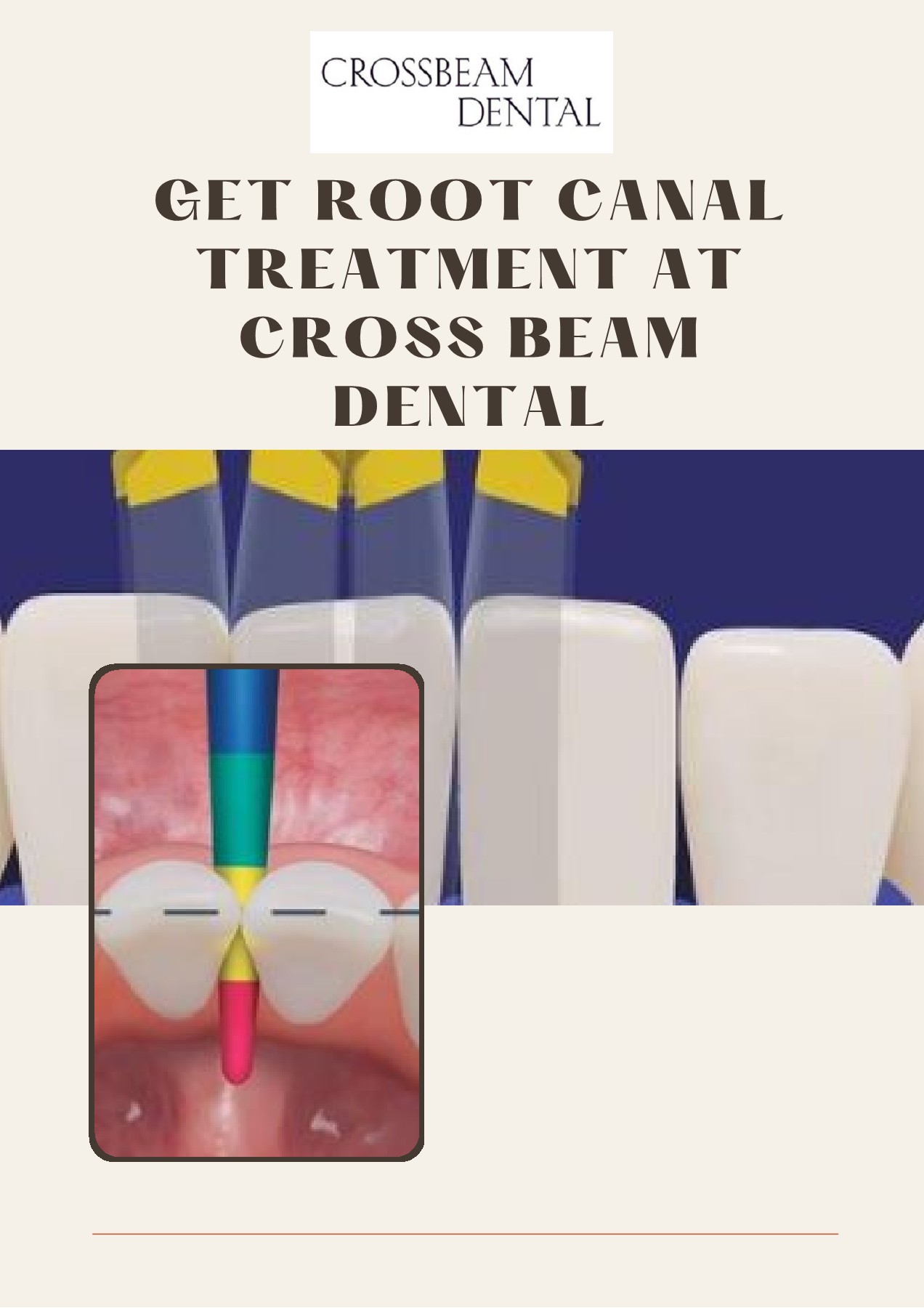 Get Root Canal Treatment at Cross Beam Dental Crossbeam Dental Page