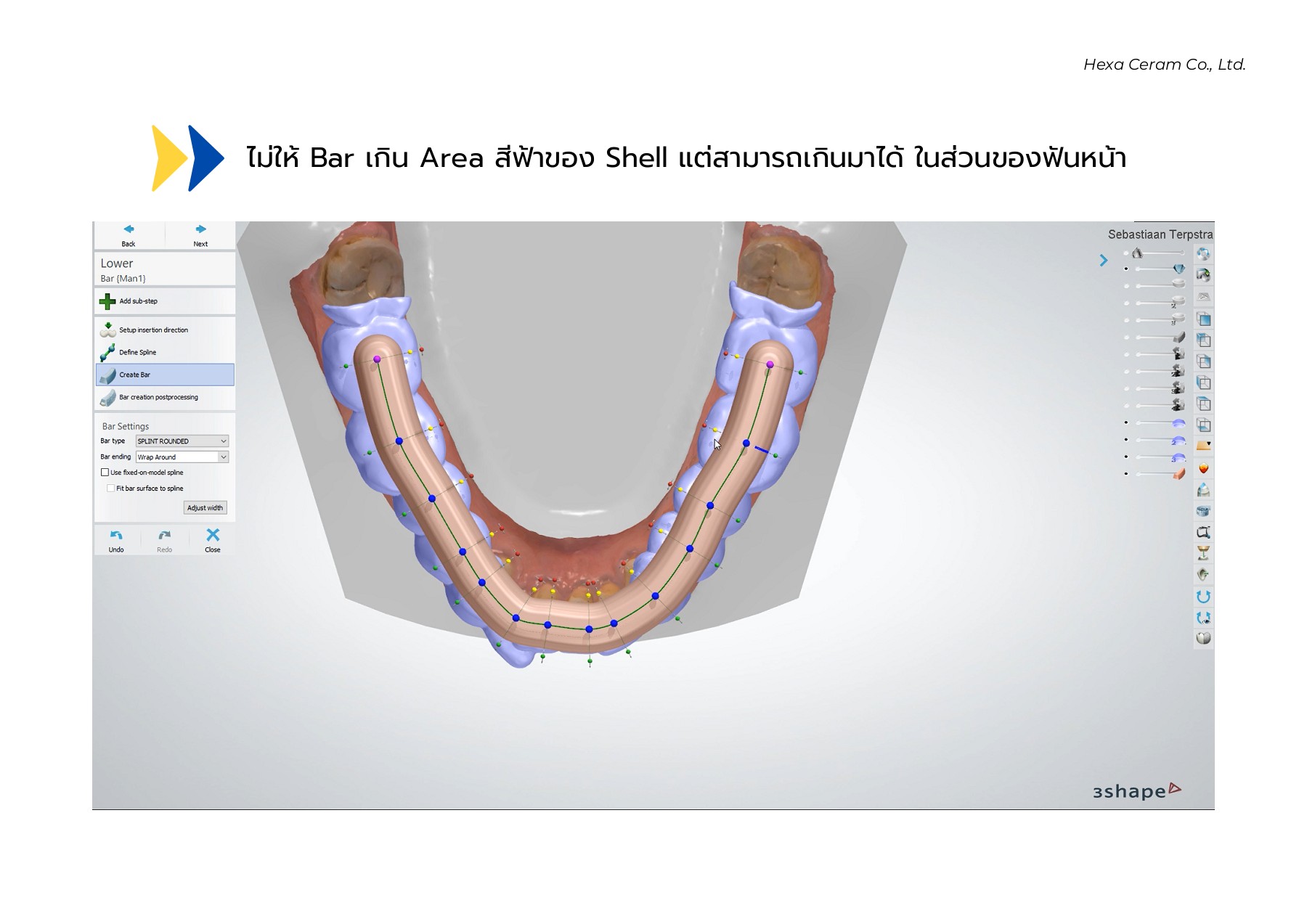 Ortho - ALLESSIE (ฟันล่าง) - Hexa Ceram Library - หน้าหนังสือ 34 | พลิก ...