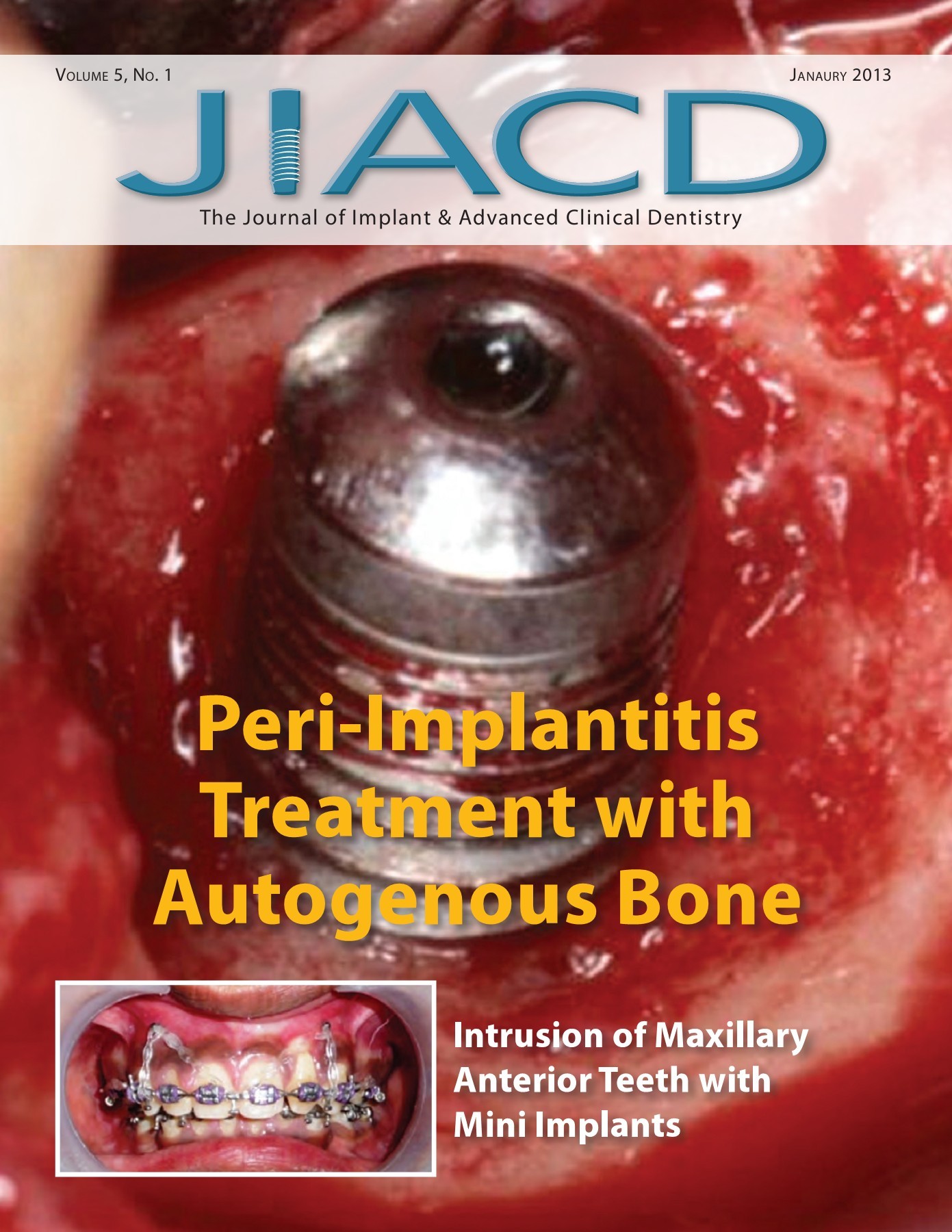 Journal of Implant and Advanced Clinical Dentistry January 2013 JIACD